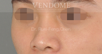img_BA_nose surgery 9 img_BA_nose surgery 9